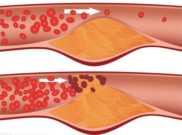 复方血栓通软胶囊改善微循环保护微血管